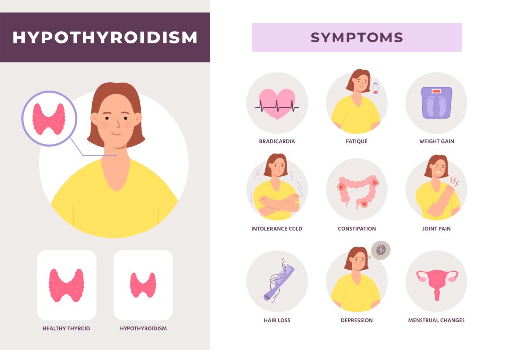 Hypothyroidism disease symptoms Underactive thyroid gland. Endocrine system health problem Illustration of hyperthyroidism and endocrinology