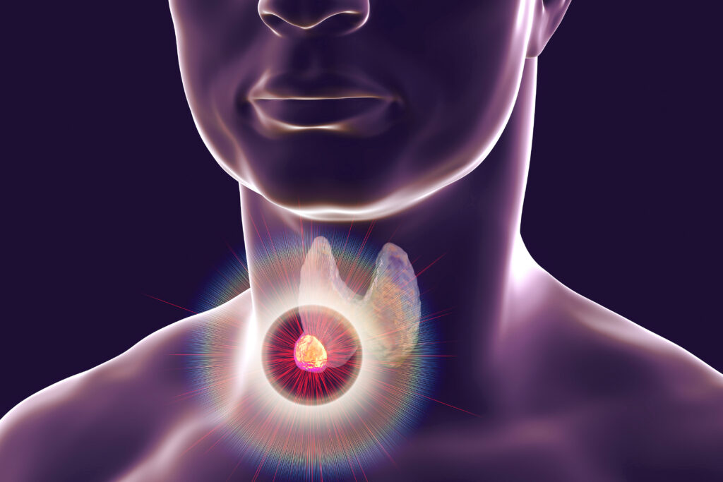 Destruction of thyroid tumor, 3D illustration. Conceptual image for thyroid cancer treatment